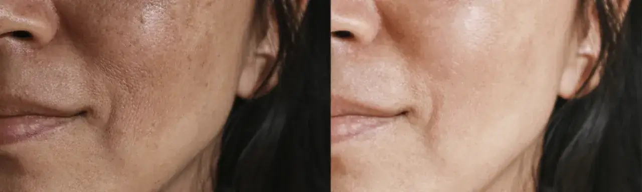 profesjonalne zabiegi na przebarwienia twarzy