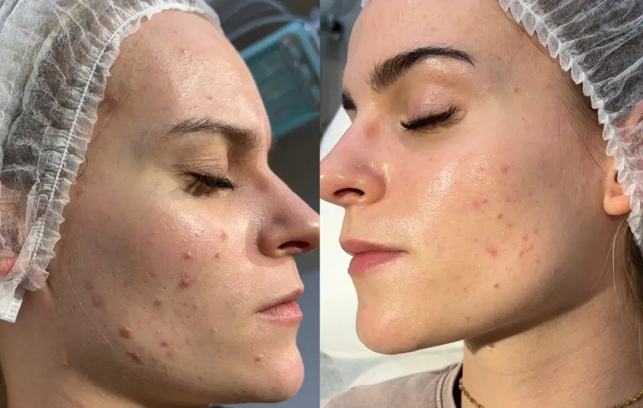 rodzaje blizn potrądzikowych zdjęcia porównanie