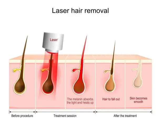 różne typy laserów do depilacji grafika porównanie