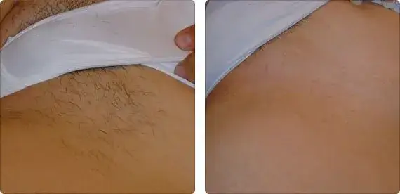 depilacja laserowa bikini przygotowania harmonogram