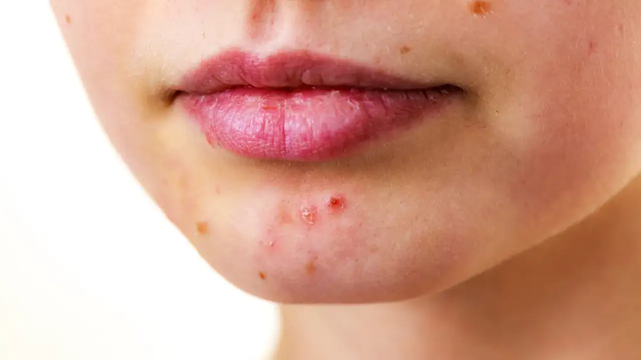 Kiedy iść do dermatologa z bliznami po trądziku