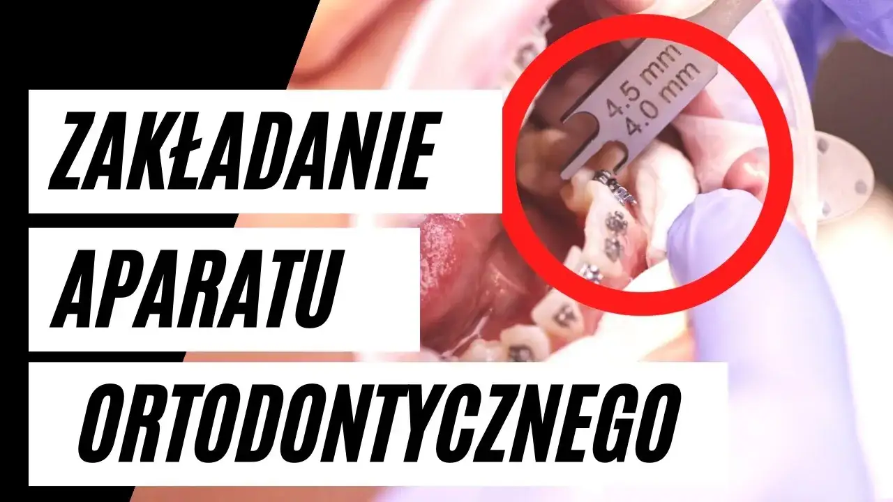 zakładanie aparatu ortodontycznego krok po kroku