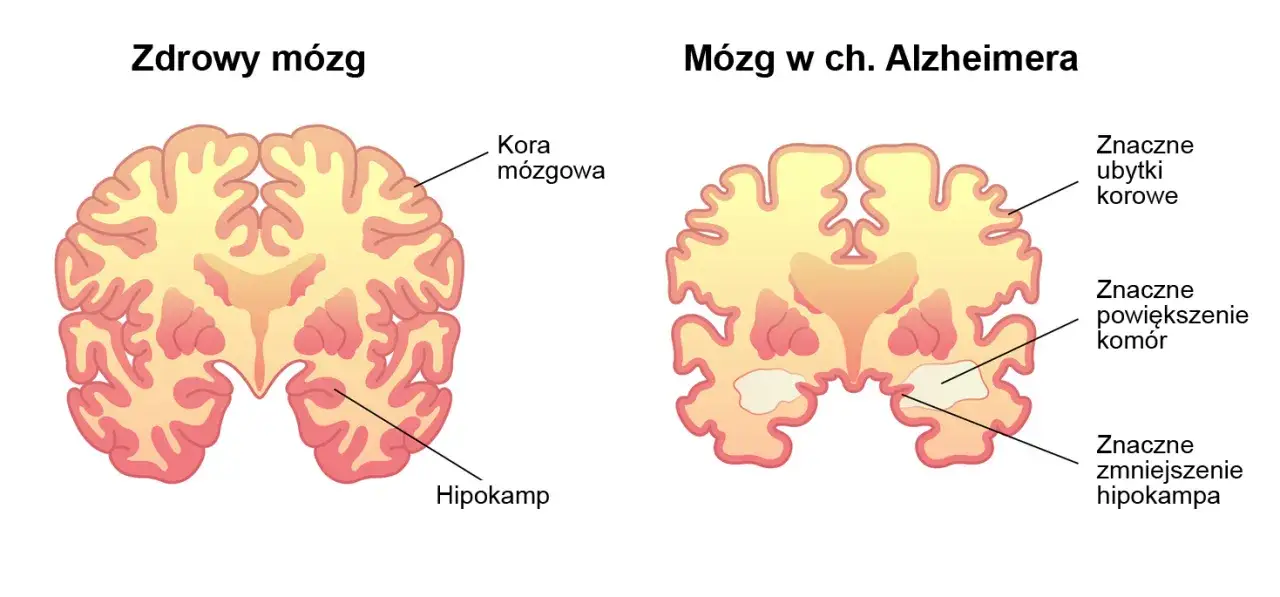 różnica między zdrowym mózgiem a mózgiem z chorobą Alzheimera