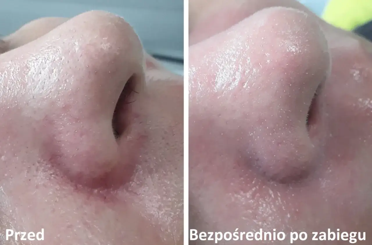 laser naczyniowy na przebarwienia