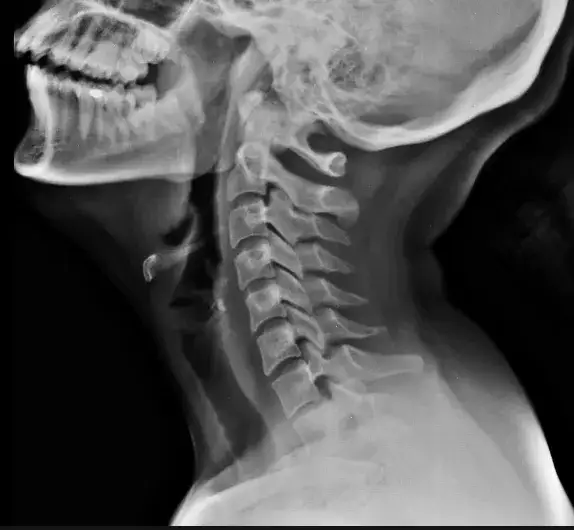 diagnostyka skręcenia kręgosłupa szyjnego RTG MRI