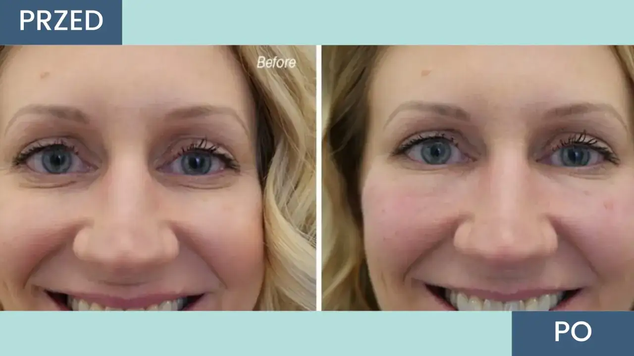 Przed i po zabiegu botoksem pod oczy. Zmarszczki wokół oczu wygładzone. Sprawdź, ile kosztuje botoks pod oczy.