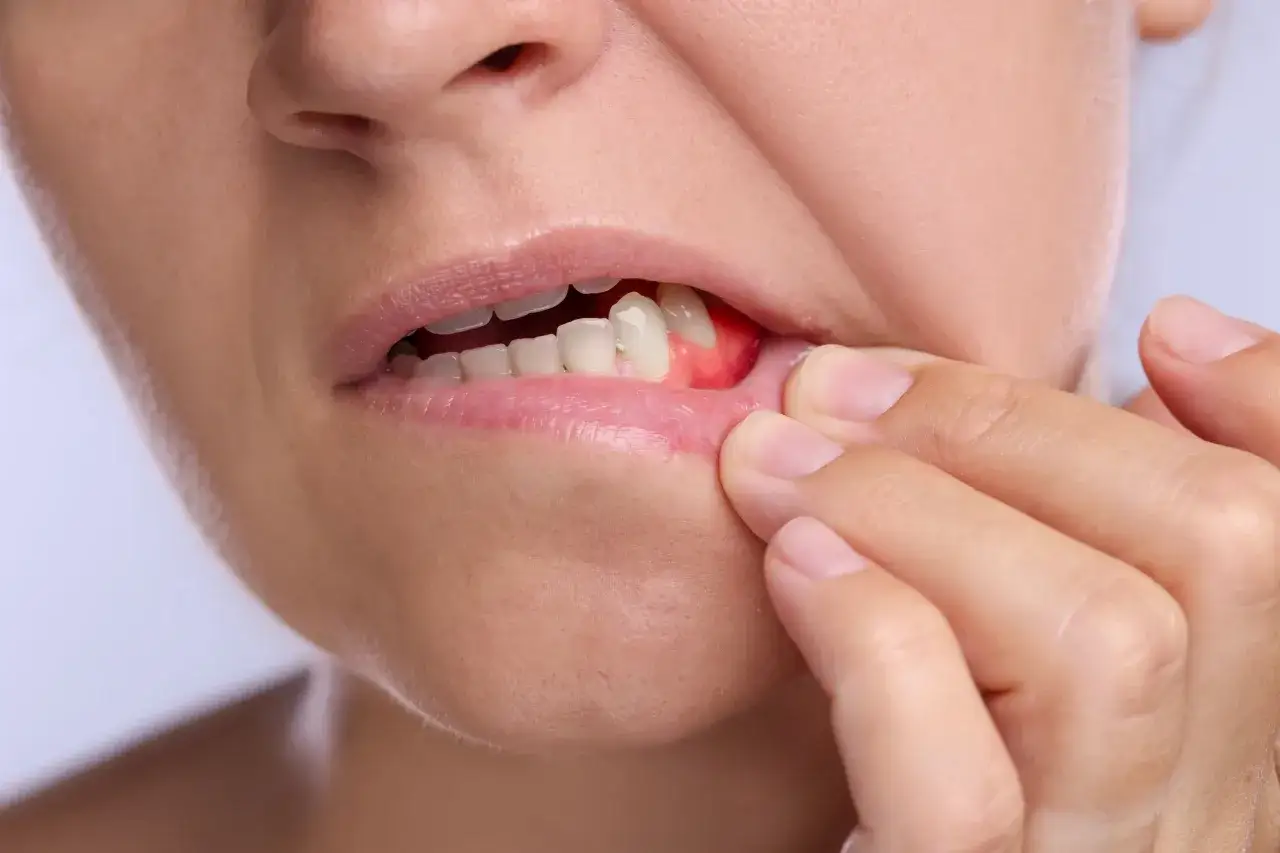 Osoba dotyka palcem zaczerwienionych, pulsujących dziąseł przy zębach.