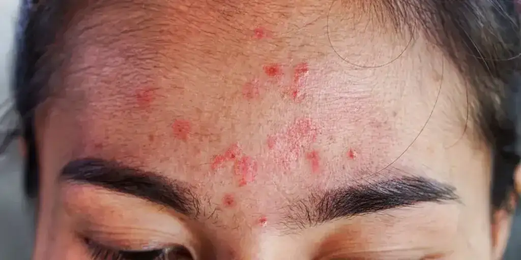 Przyczyny pryszczy na czole