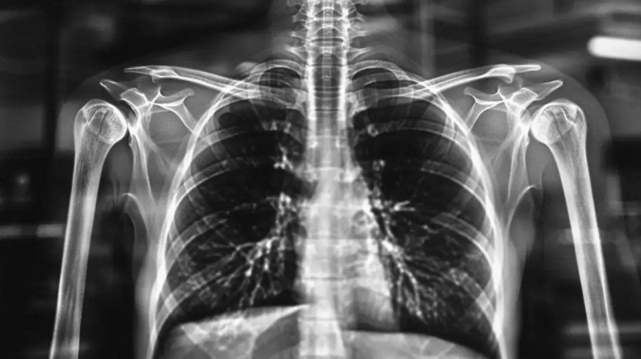 RTG klatki piersiowej. Zastanawiasz się, odma płucna ile trwa leczenie? Obraz pokazuje płuca, żebra, kręgosłup i obojczyki.