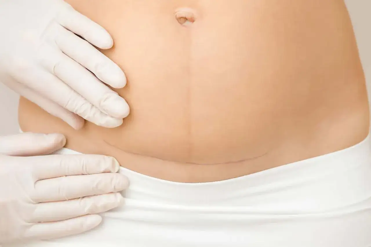 Delikatne badanie blizny po cc. Fizjoterapia po cc pomaga w powrocie do formy.