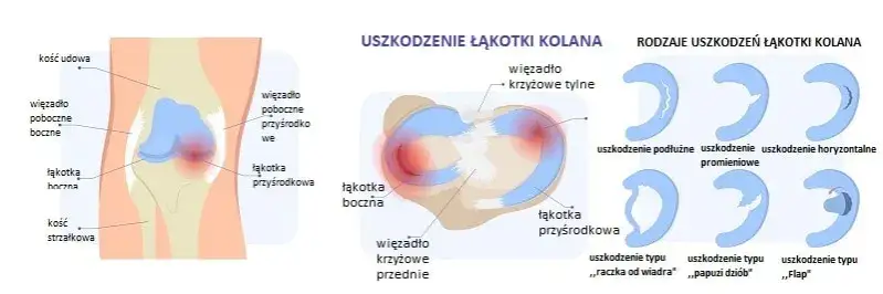 Zdjęcie Pozioma szczelina łąkotki przyśrodkowej: Jak leczyć? Porady