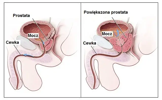 Zdjęcie Dopuszczalna wielkość prostaty: co powinieneś wiedzieć o normach zdrowotnych