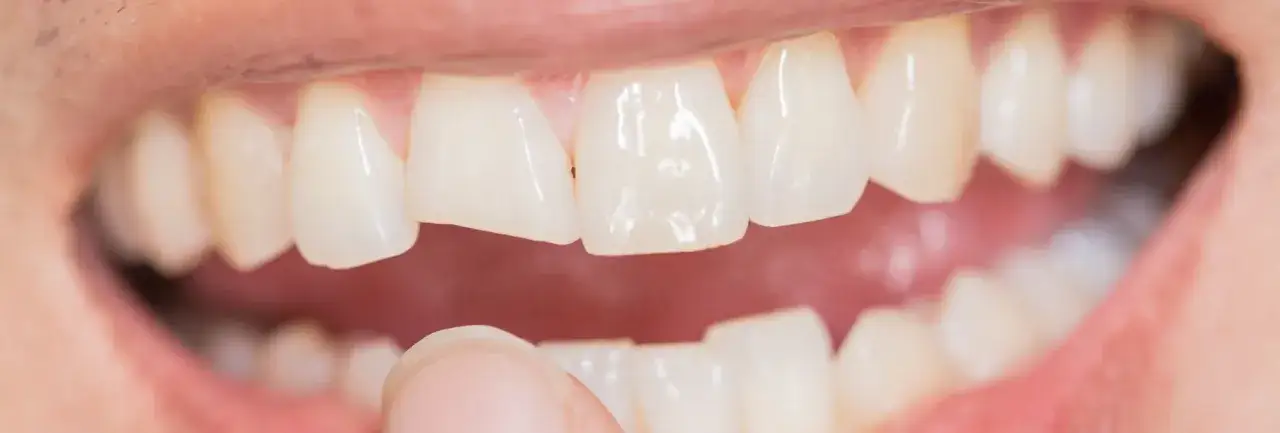 Zdjęcie Co zrobić jak ukruszy się ząb? Kluczowe kroki, by uniknąć bólu