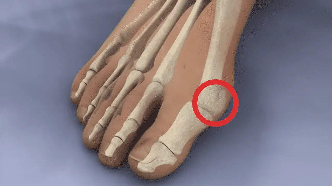 Zdjęcie Jak pozbyć się haluksów: skuteczne metody bez operacji i bólu
