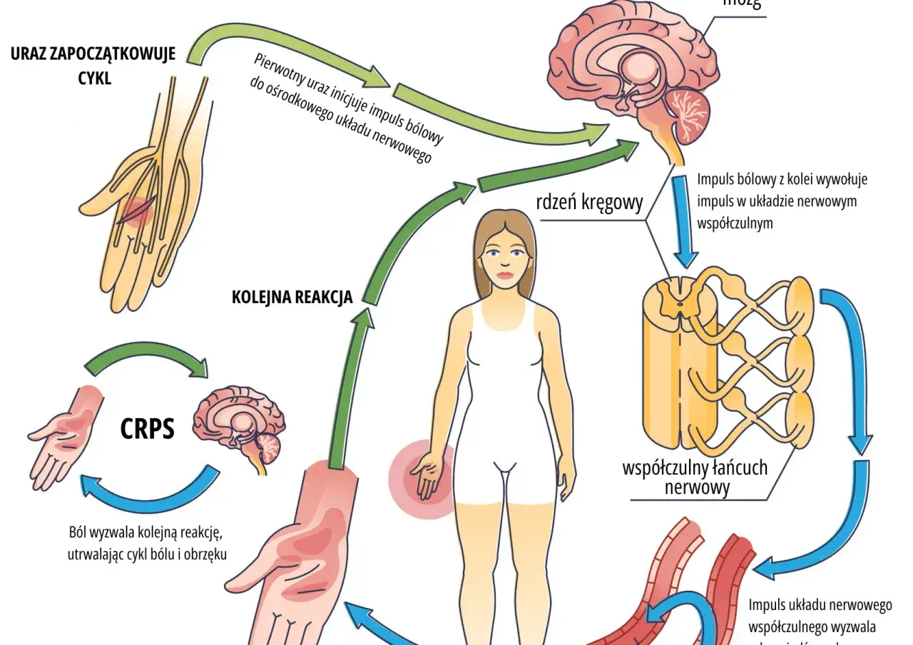Różne przyczyny bólu mięśni infografika