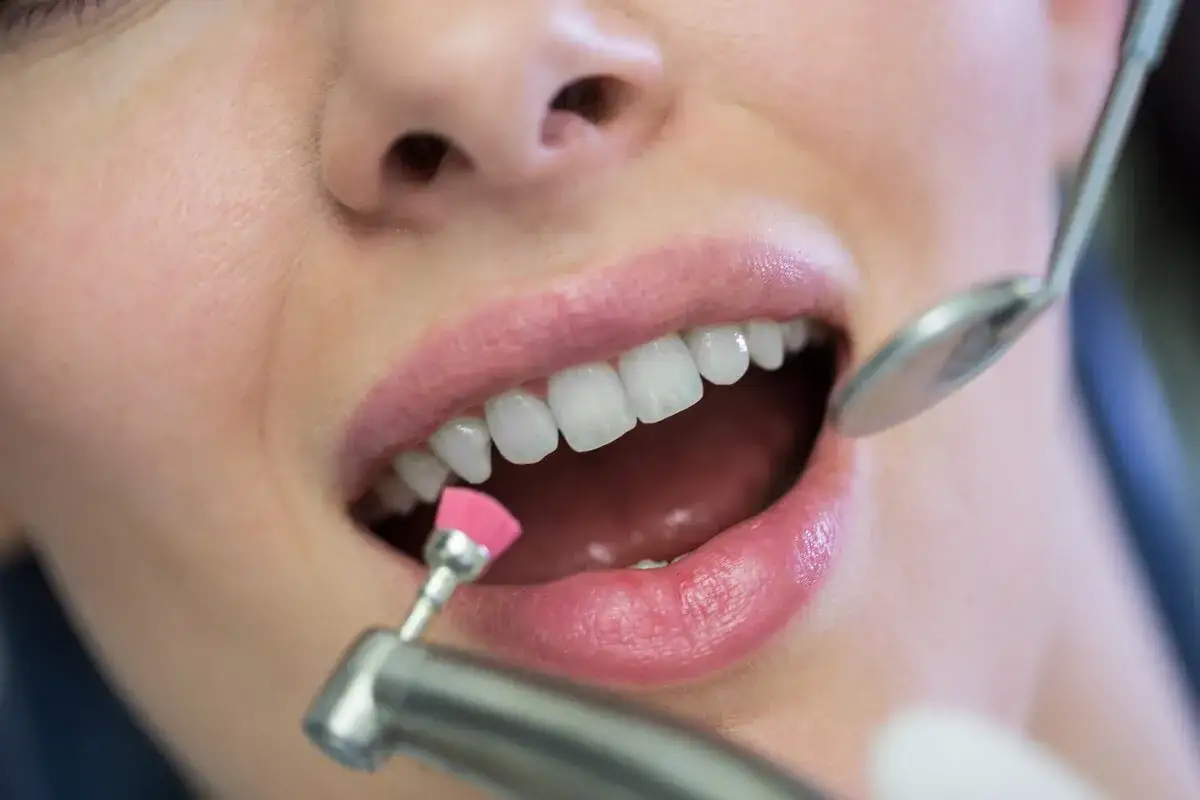 Zabieg fluoryzacji zęb&oacute;w w gabinecie dentystycznym