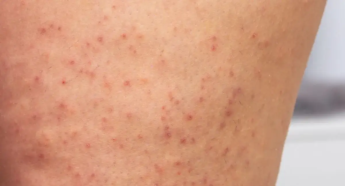 rogowacenie okołomieszkowe nogi