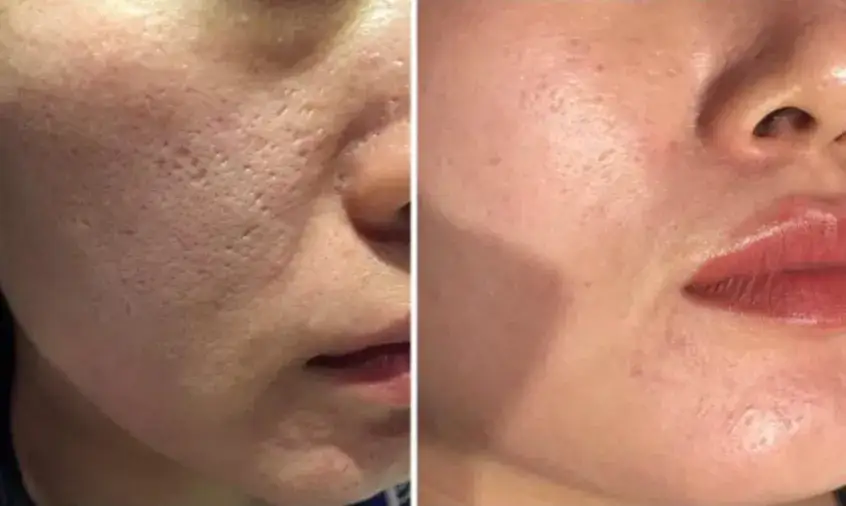 Por&oacute;wnanie zabieg&oacute;w na blizny potrądzikowe