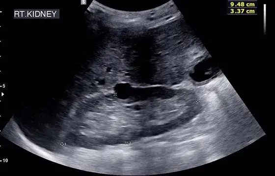 USG układu moczowego