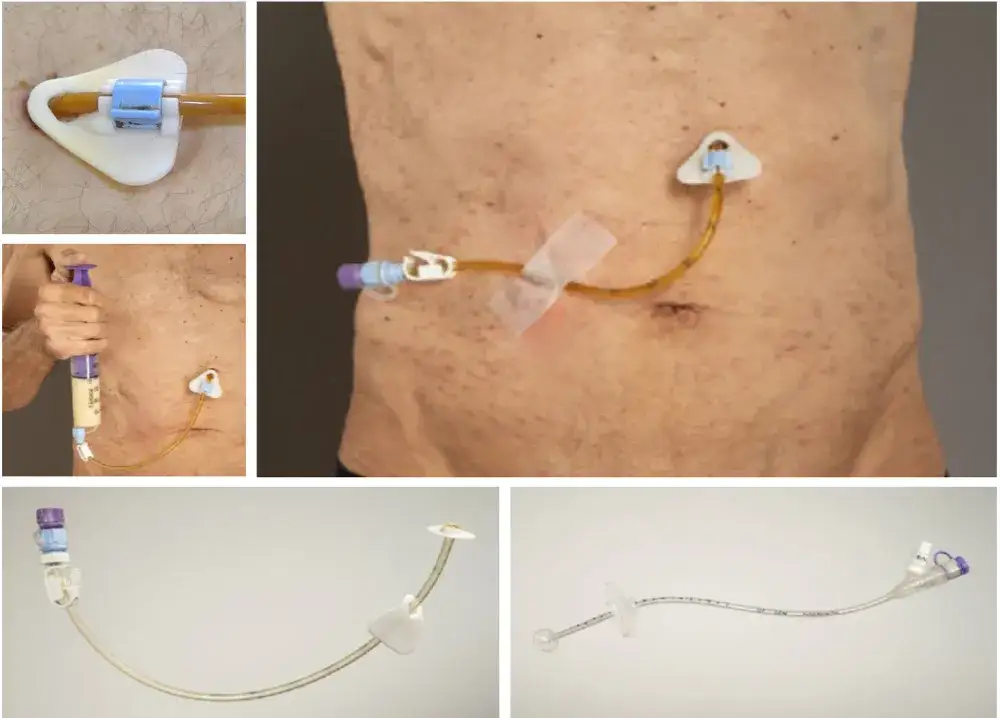 Sonda dożołądkowa i gastrostomia PEG porównanie