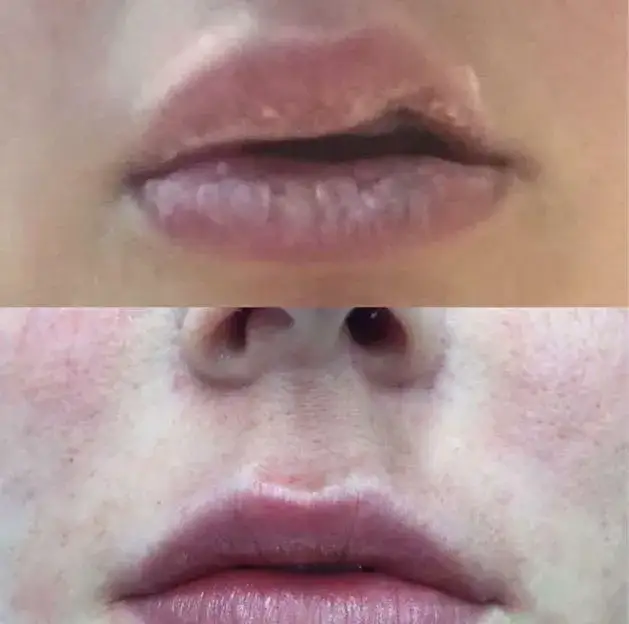 Zdjęcie Labios deformados por ácido hialurónico: causas, consecuencias y soluciones