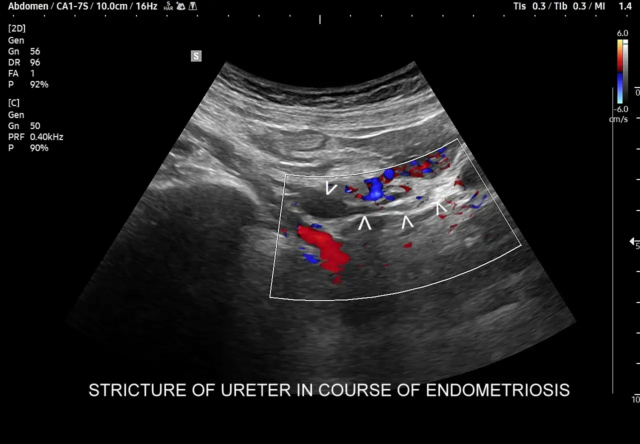 Zwężenie moczowodu w przebiegu endometriozy. Kolorowy Doppler pokazuje przepływ krwi w naczyniach.
