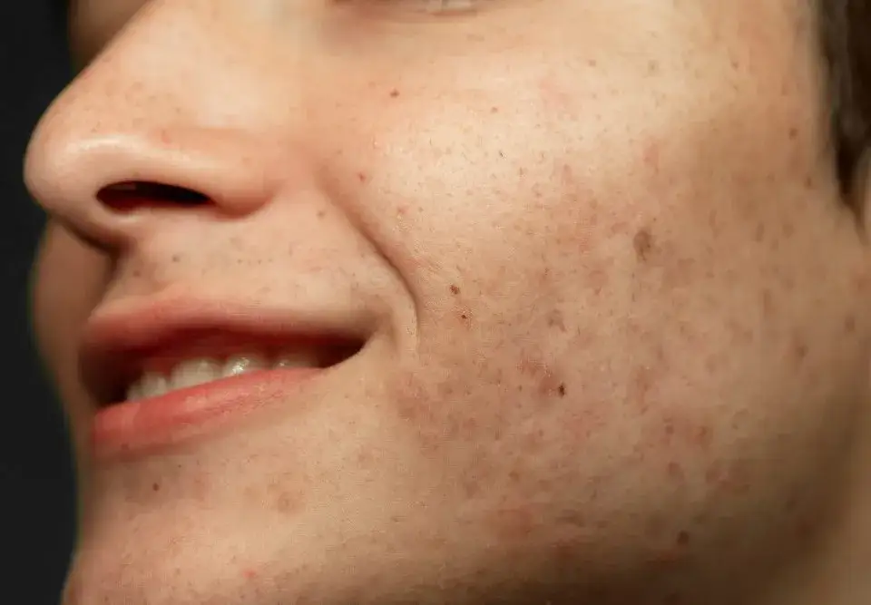 Zdjęcie Kiedy najlepiej zrobić laser frakcyjny, aby uniknąć powikłań?