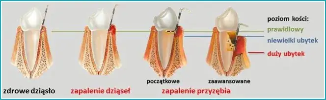różne przyczyny bólu dziąseł infografika