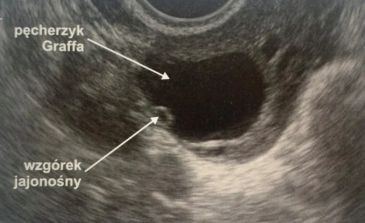 USG pęcherzyk Graafa wzrost