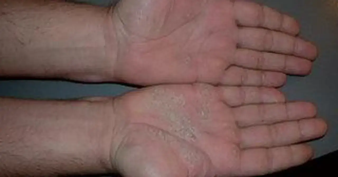 Dłonie z widocznymi zmianami skórnymi, łuszczeniem i zaczerwienieniem. Objawy sugerują choroby skóry dłoni.
