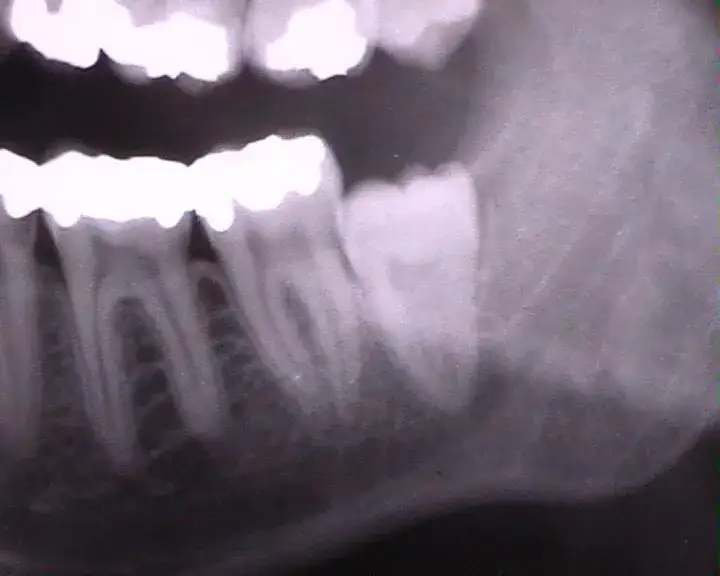 Zdjęcie Rosnący ząb mądrości: skuteczne metody na ból i ulgę