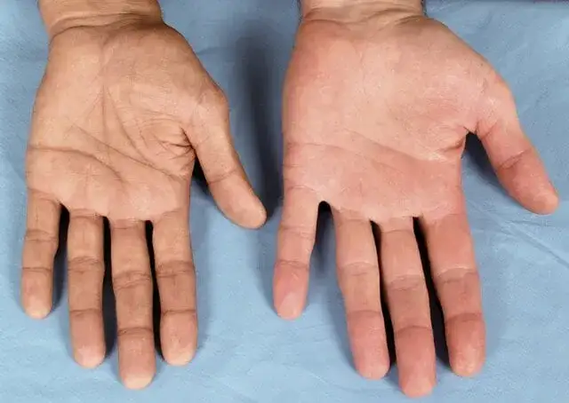 Zdjęcie Choroba Addisona objawy - jak je rozpoznać i uniknąć powikłań