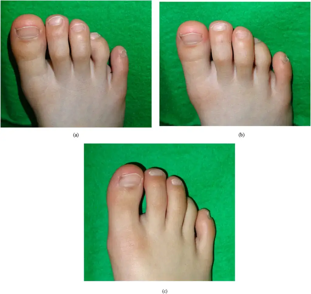 Zdjęcie Krzywy palec u nóg dziecka: przyczyny, objawy i skuteczne leczenie