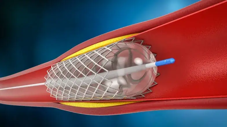 stent naczyniowy