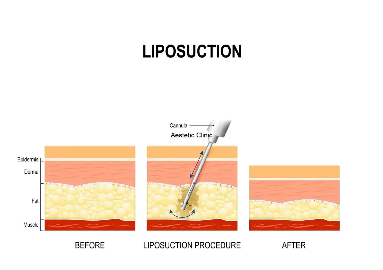R&oacute;żne metody liposukcji infografika