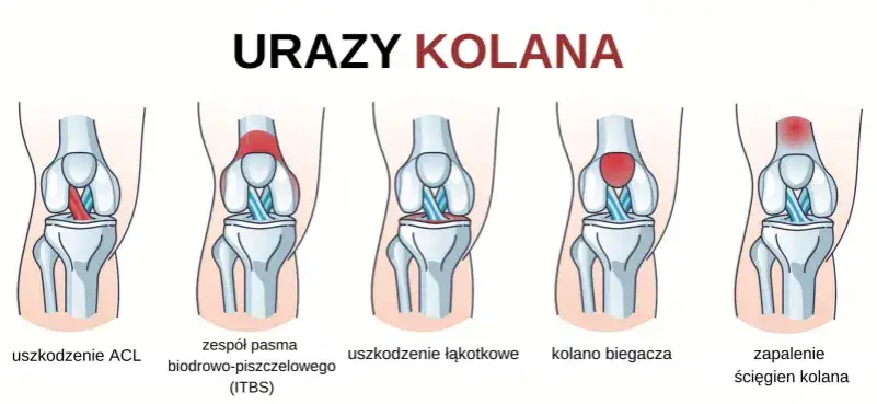 mapa b&oacute;lu kolana biegacza