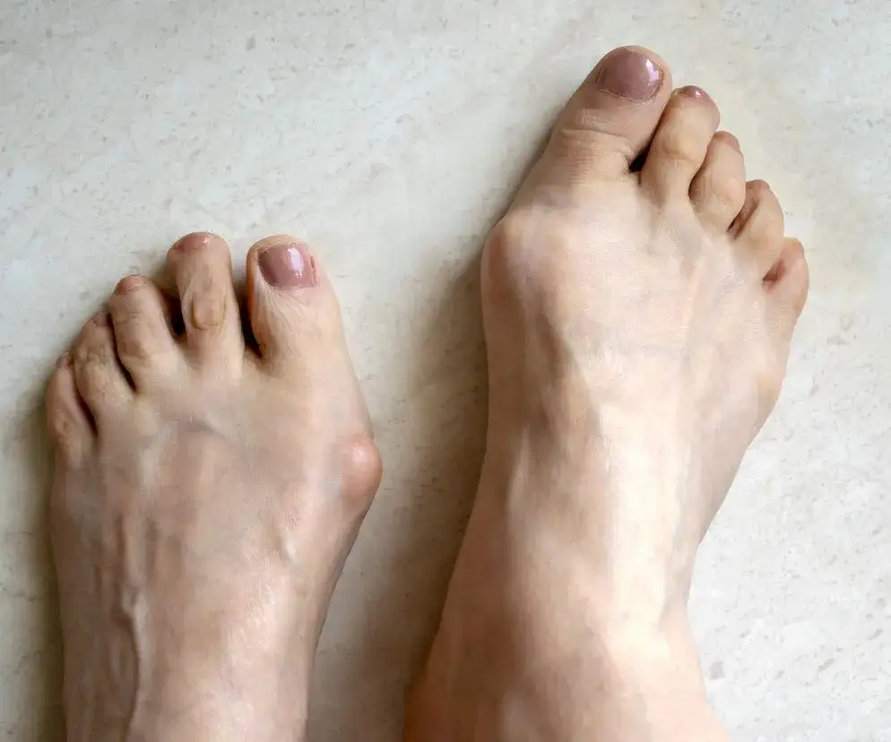 przyczyny zapalenia haluksa