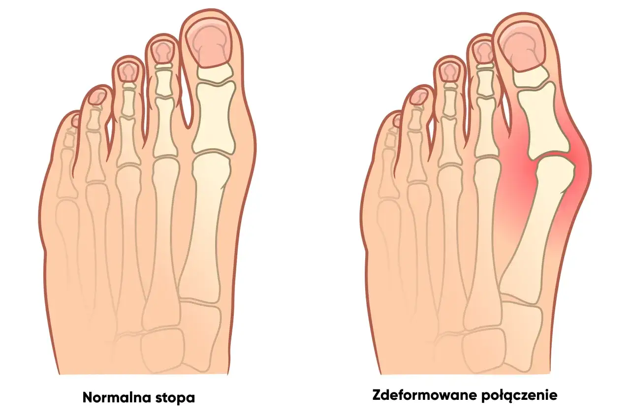 Zdjęcie stopy z haluksem i zdrowej stopy