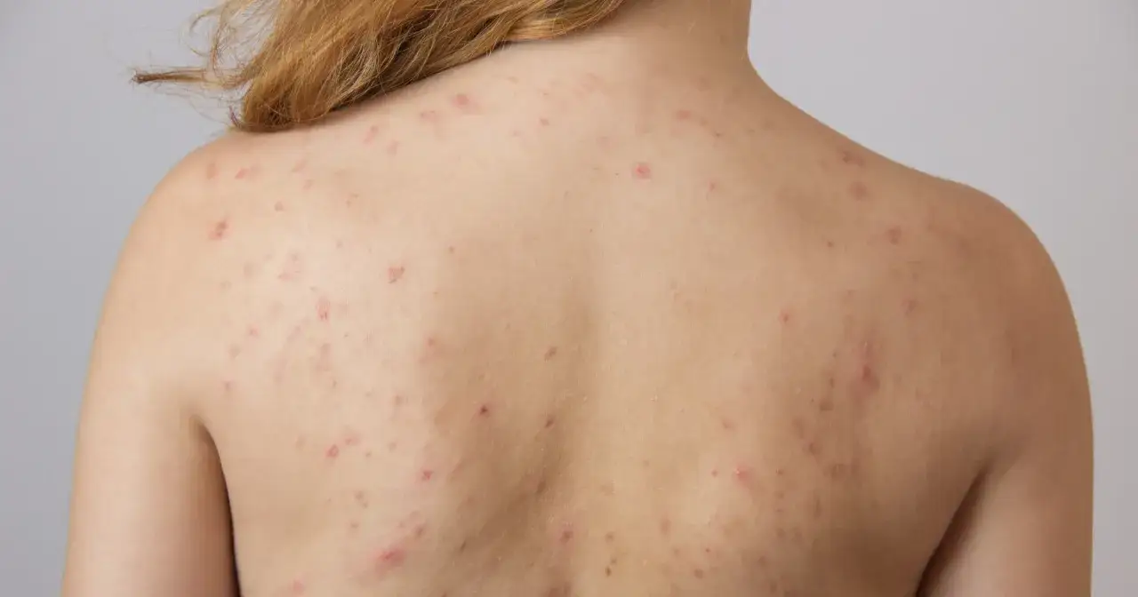 Pielęgnacja sk&oacute;ry z trądzikiem na plecach