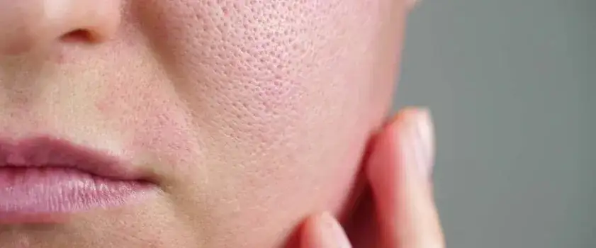 Zdjęcie Jak dbać o cerę tłustą: skuteczne sposoby na piękną skórę