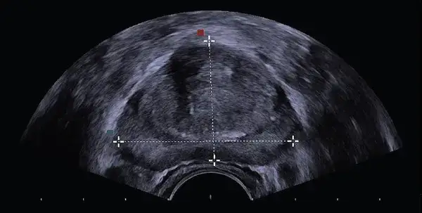 obraz usg prostaty trus