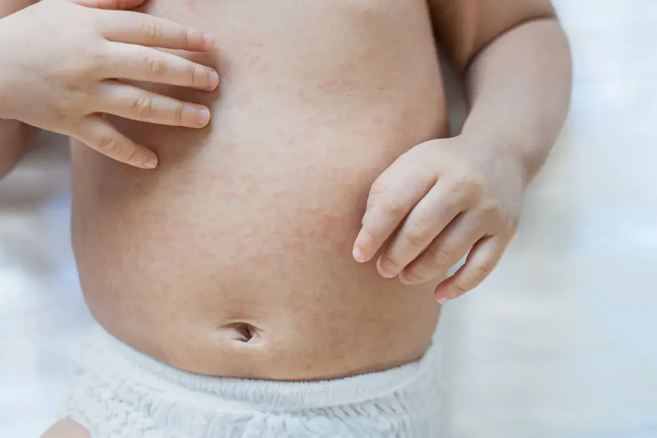Brzuszek dziecka pokryty drobną, czerwoną wysypką. Czy to r&oacute;życzka czy uczulenie?