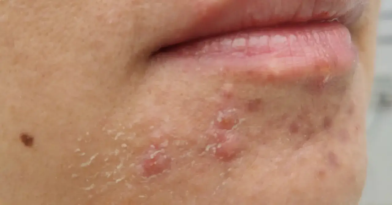 pryszcze na brodzie przyczyny