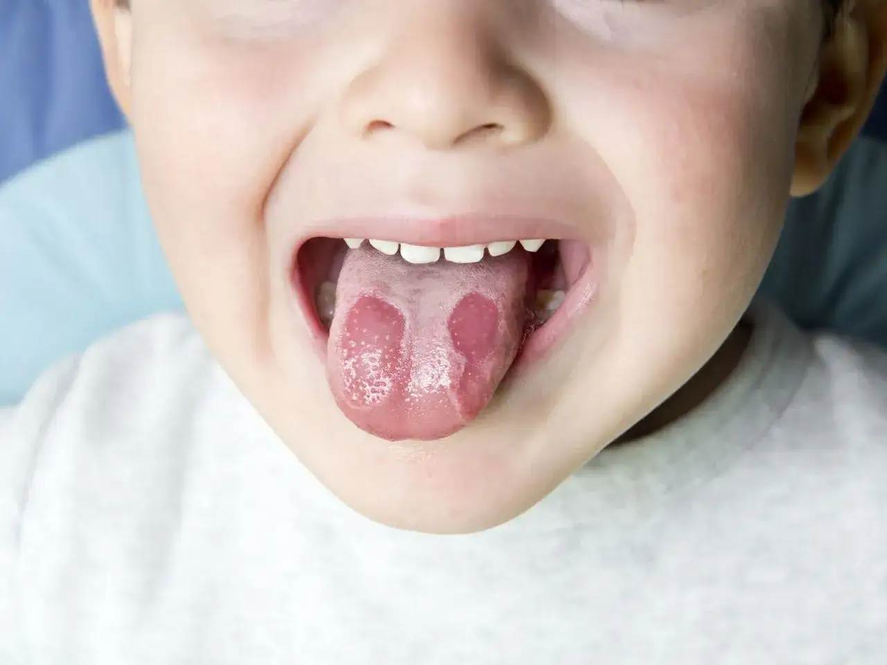 Dziecko pokazuje język z plamami, kt&oacute;re przypominają mapę. To język geograficzny, kt&oacute;ry może wyglądać jak mała podr&oacute;ż po nieznanych lądach.