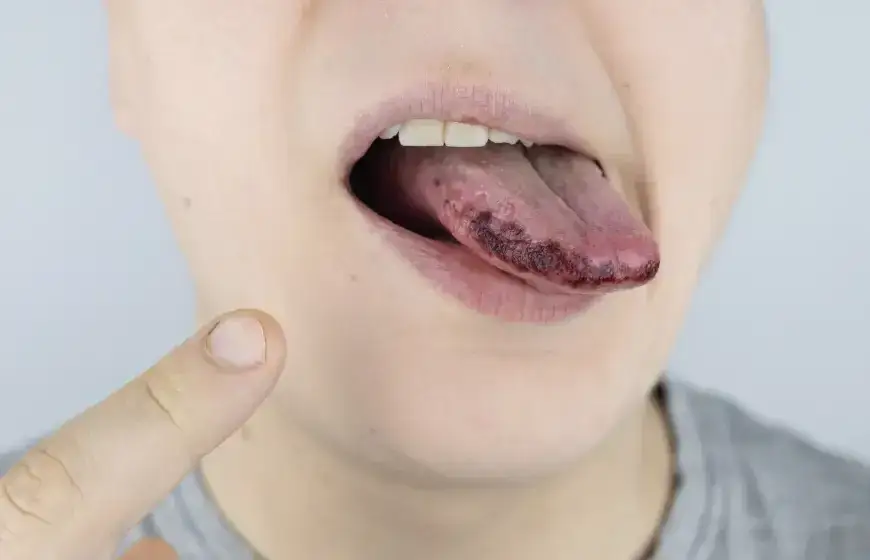 zniszczone dziąsła amfetamina