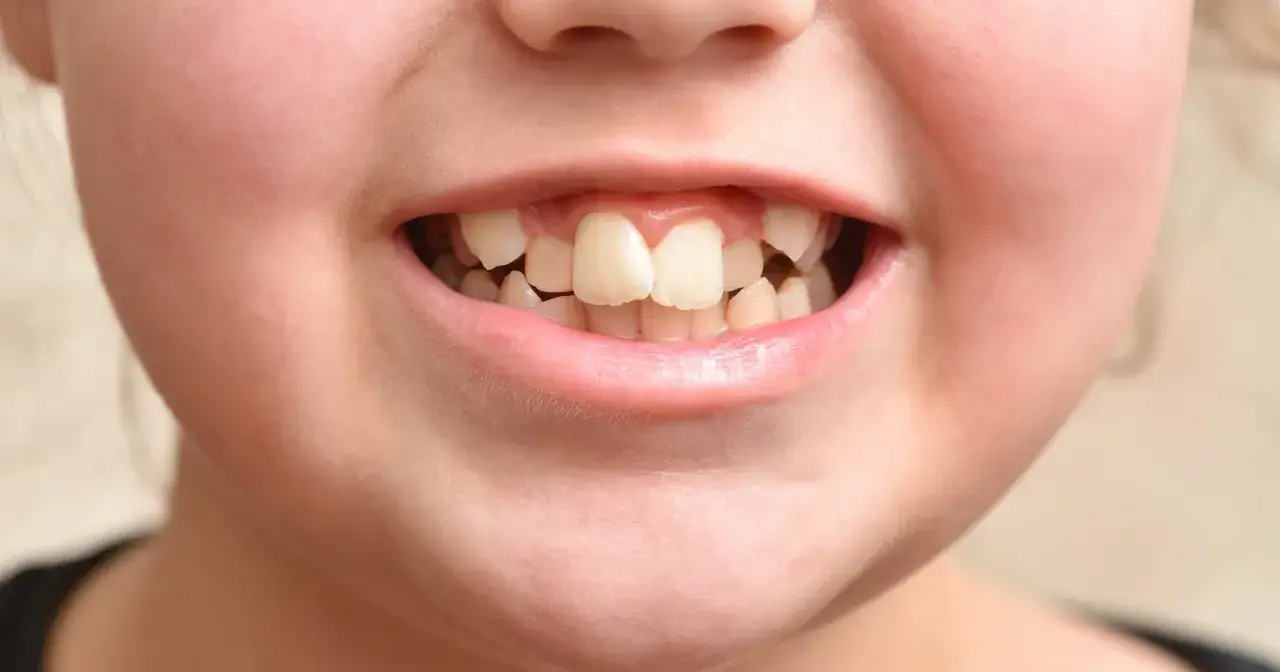 Uśmiechnięta buzia dziecka z widocznymi zębami. Piąty ząb od środka jest lekko przekrzywiony.