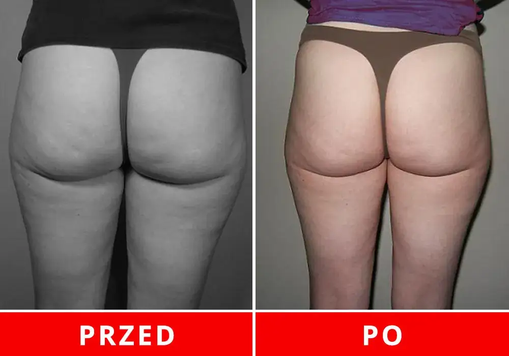 Bieganie wpływ na cellulit przed po