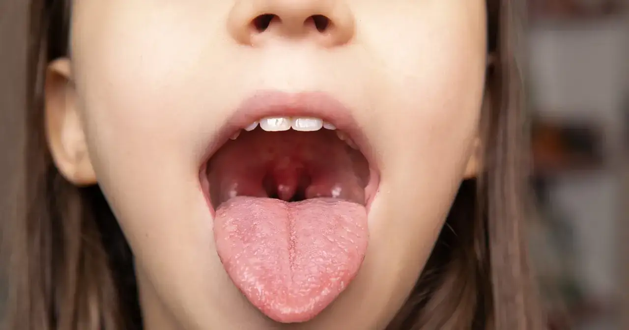 Dziecko z otwartymi ustami, pokazujące zaczerwienione gardło i migdałki, co może sugerować ból przy przełykaniu.
