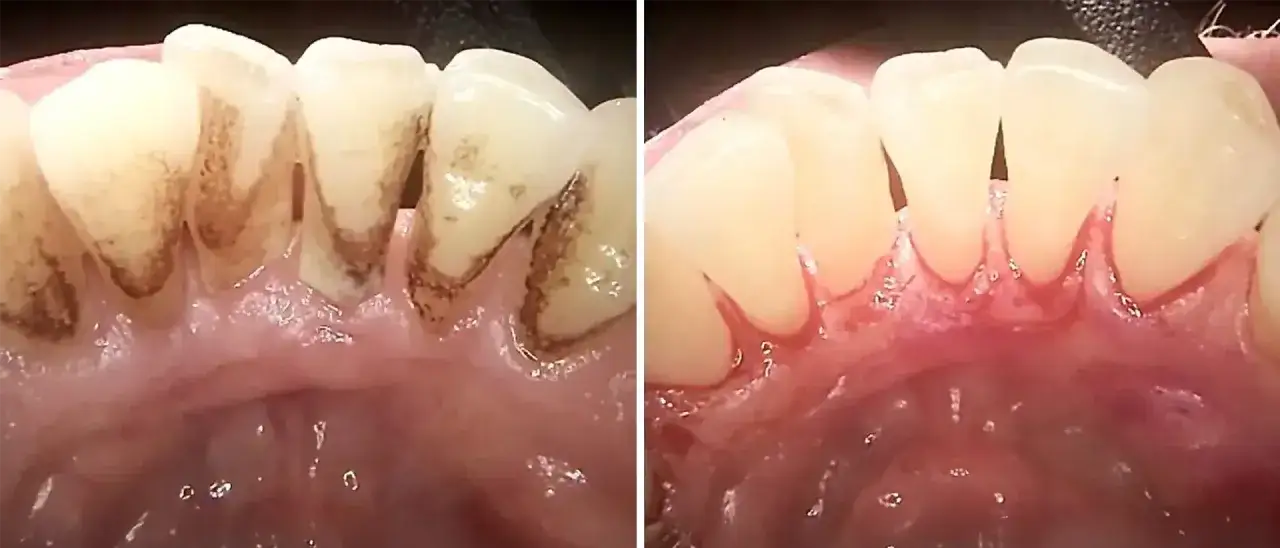 Przed i po: zęby z osadem i zdrowe dziąsła, bez widocznej dziury w dziąśle.