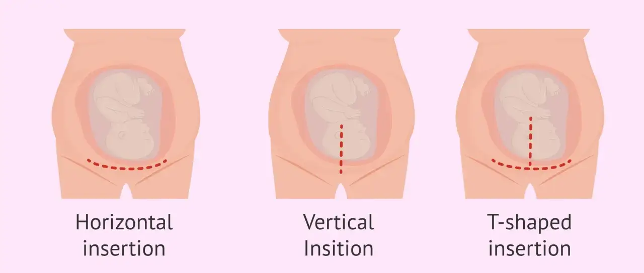 Trzy rodzaje nacięć przy cesarce: poziome, pionowe i T-kształtne. Czas trwania cesarki zależy od wielu czynnik&oacute;w.